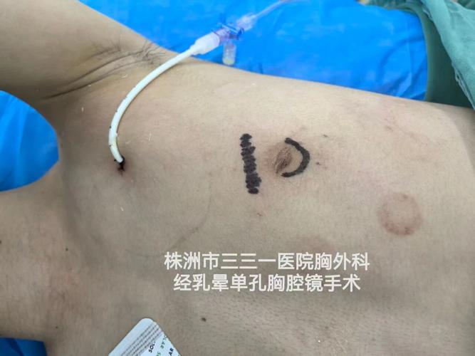 因气胸缺席至今！活塞官方：坎宁安正在康复将在一周后接受复查